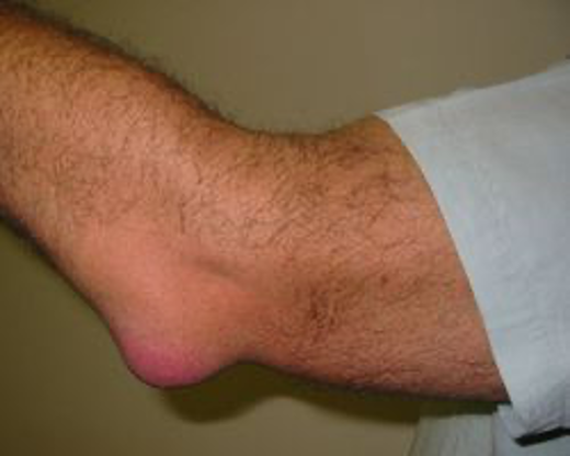 Olecranon Bursitis