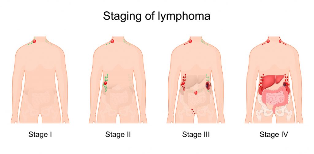 Hodgkin symptomen
