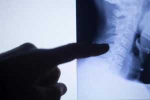 Lees meer over het artikel Slijtage in de onderrug