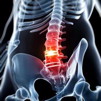 Lees meer over het artikel Wat is eigenlijk een hernia?