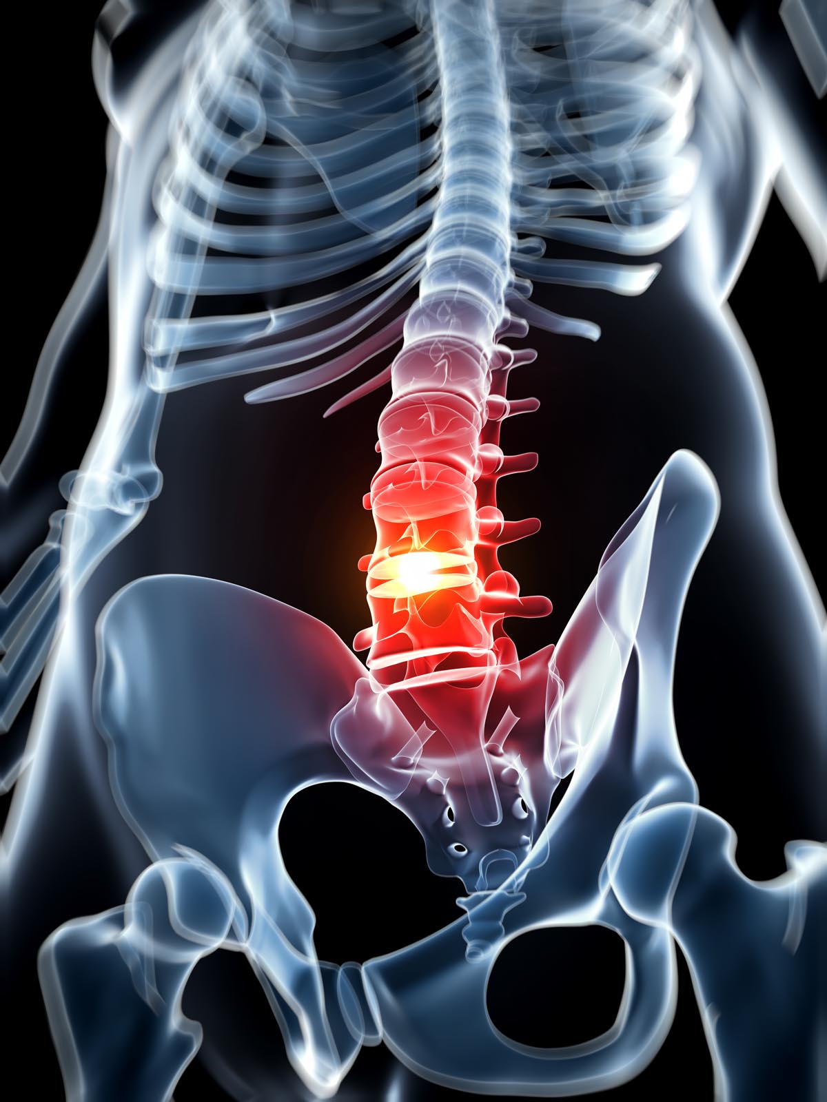 Wat is eigenlijk een hernia ?
