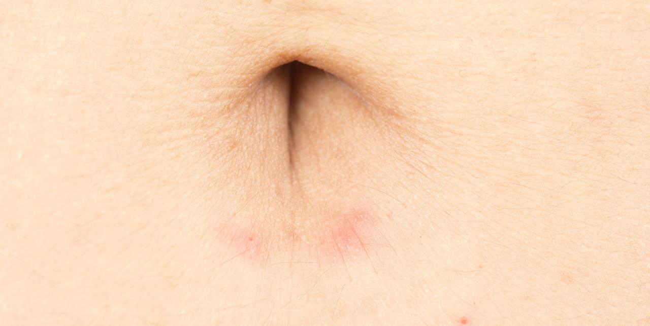 Lees meer over het artikel Navel uitslag
